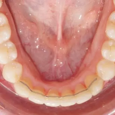 fil de contention collée Pornic