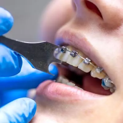 pose appareil dentaire Pornic