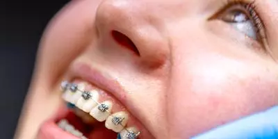 appareil dentaire adolescent Pornic