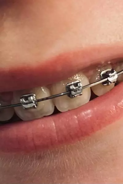 appareil dentaire adolescents pornic