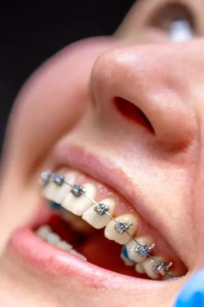 appareil dentaire adolescent Pornic